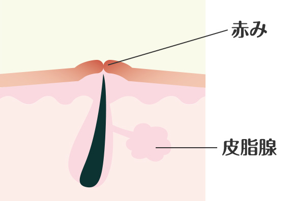 ニキビ跡赤み仕組み