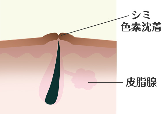 色素沈着仕組み