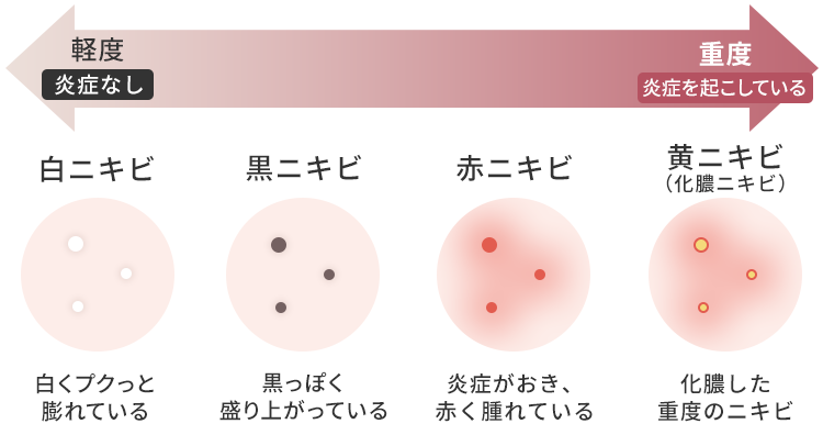 どうしてニキビ跡ができるの？
