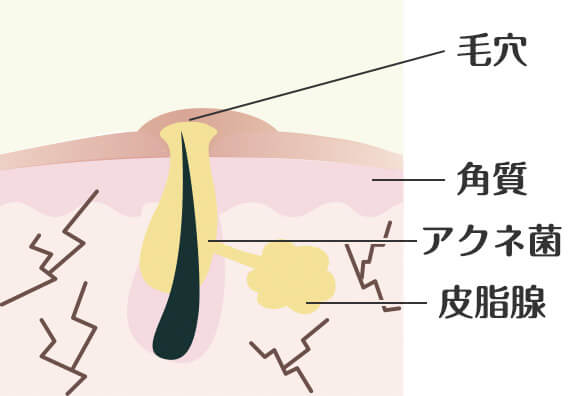 「角化」によって毛穴が詰まる