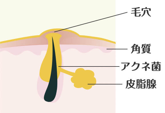 皮脂が過剰に分泌される