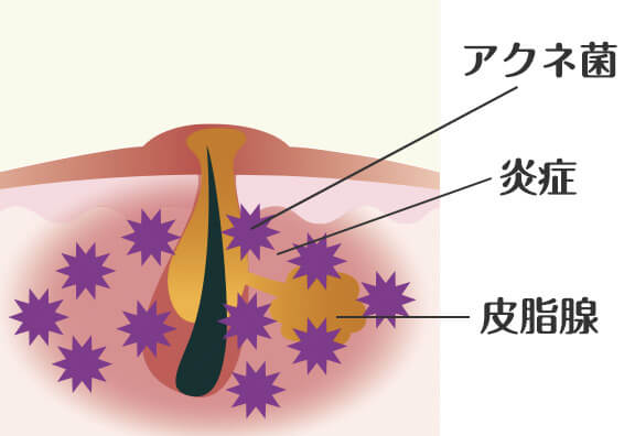 アクネ菌が繁殖する