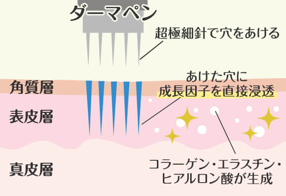 ダーマペンの仕組み