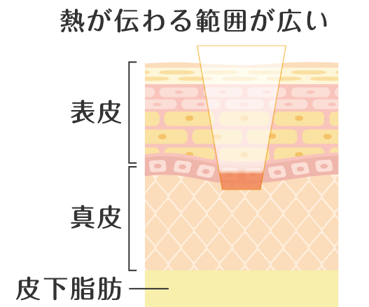 一般的なレーザー治療