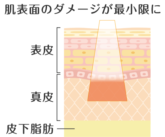 フラクショナルRF治療