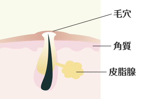 ニキビの種類：白ニキビ