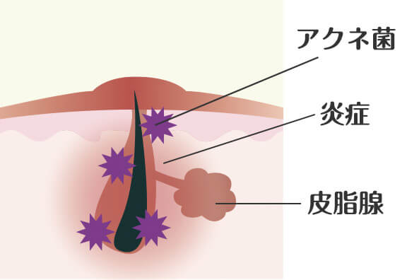 ニキビの種類：赤ニキビ