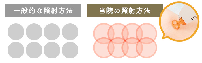 レーザー脱毛照射方法