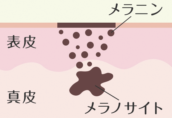 レーザートーニング 高い効果を実現するしくみ