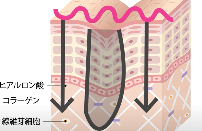 ニキビ跡や毛穴の治療方法とは?