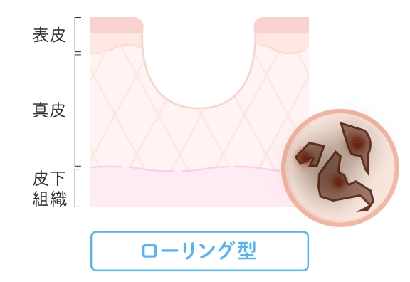 ローリング型