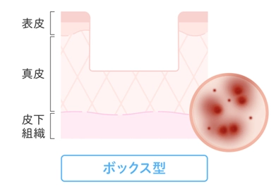 ボックス型