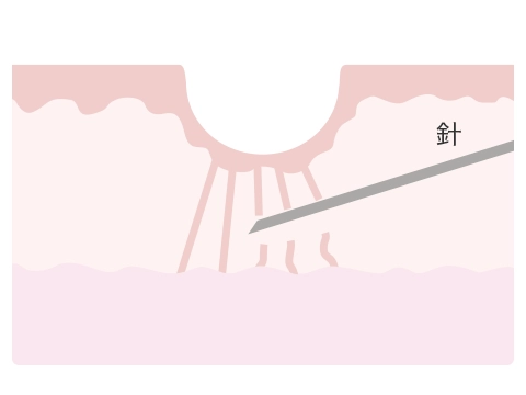 ②癒着して硬くなった繊維を針で切り離します