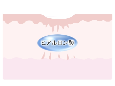 ④ヒアルロン酸などを注入し、再癒着を防ぎ肌質改善も促します