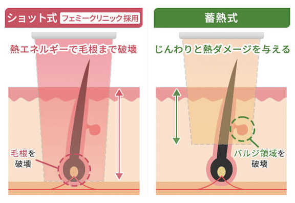 エステ脱毛と医療脱毛