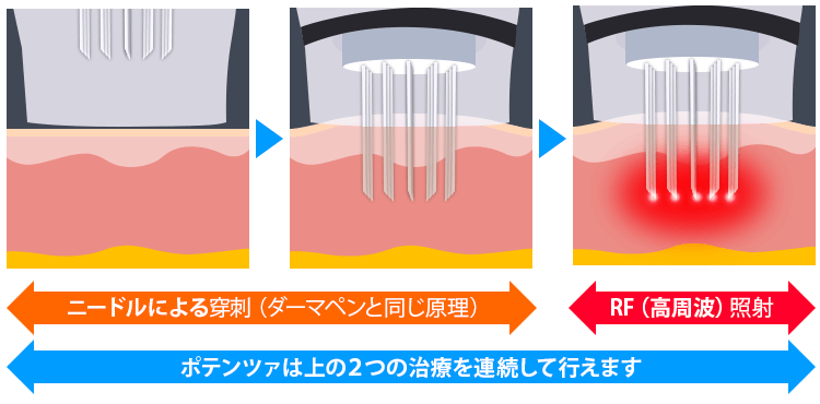 ポテンツァの効果