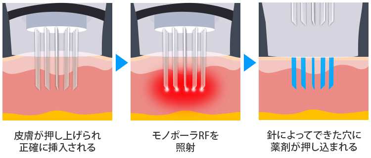 ポテンツァのマイクロニードル
