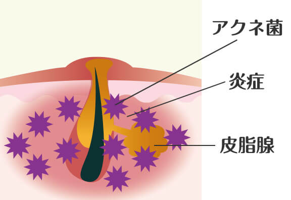 黄ニキビ（化膿ニキビ）