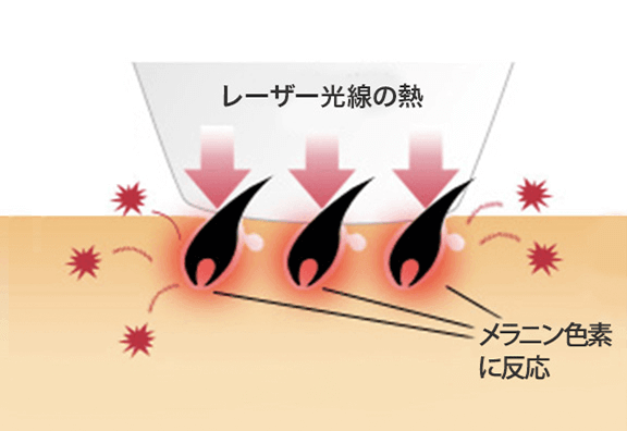 メラニンに反応し脱毛する