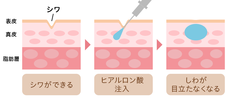 ヒアルロン酸注入の効果