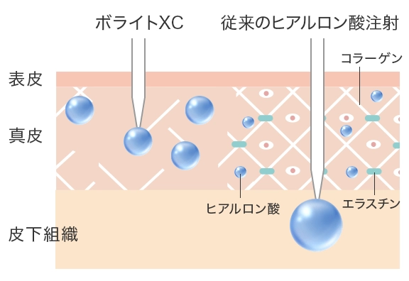 肌質改善を目的としたボライト（スキンバイブ）