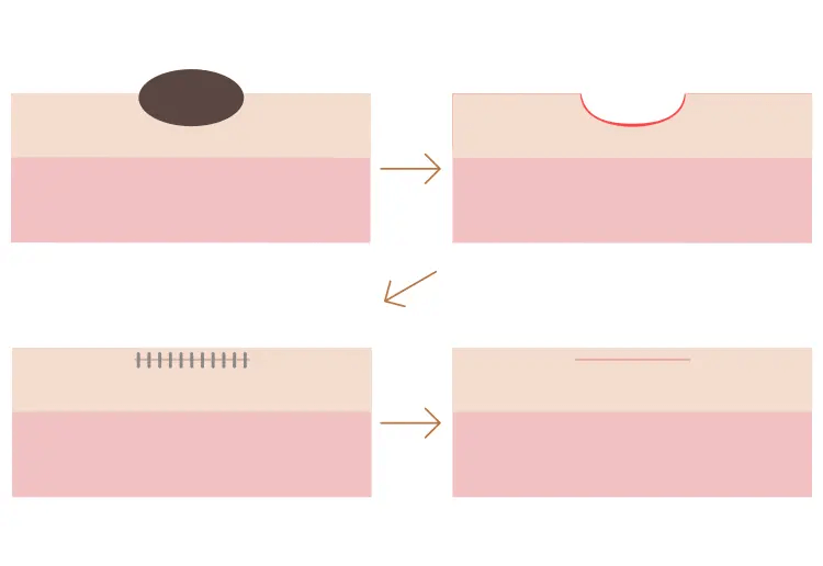 イボ・ほくろ除去治療の種類：切縫法